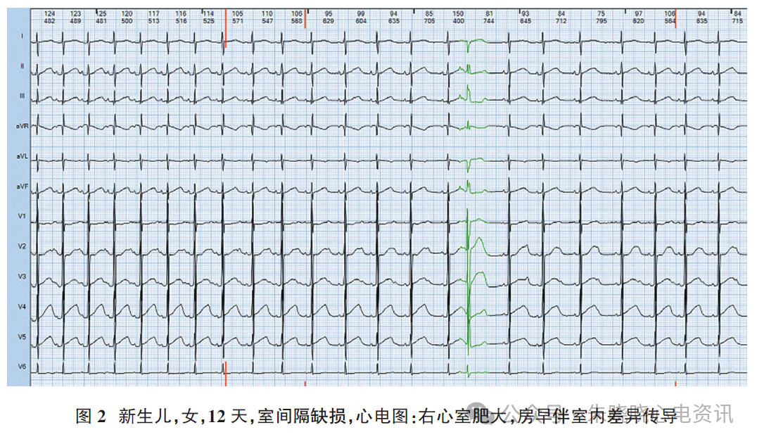 胎儿心电图是什么意思新生儿心电图精要_https://www.jmylbn.com_新闻资讯_第5张