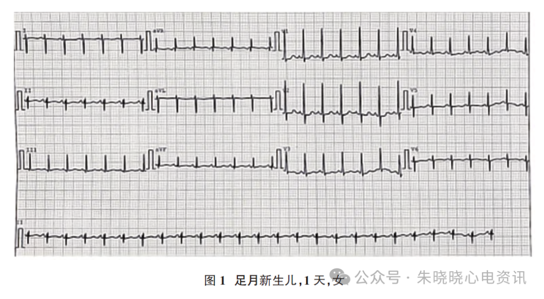 胎儿心电图是什么意思新生儿心电图精要_https://www.jmylbn.com_新闻资讯_第4张