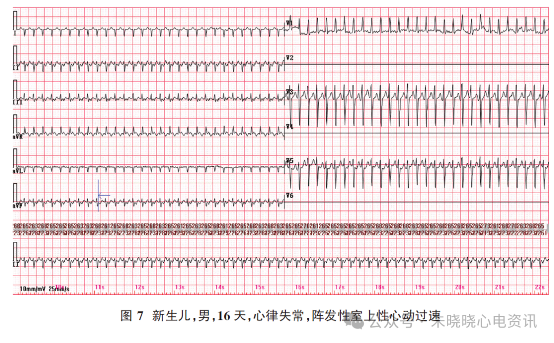 胎儿心电图是什么意思新生儿心电图精要_https://www.jmylbn.com_新闻资讯_第10张