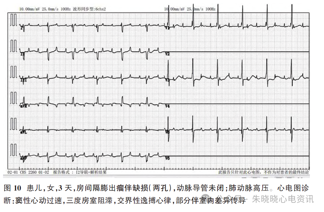 胎儿心电图是什么意思新生儿心电图精要_https://www.jmylbn.com_新闻资讯_第13张