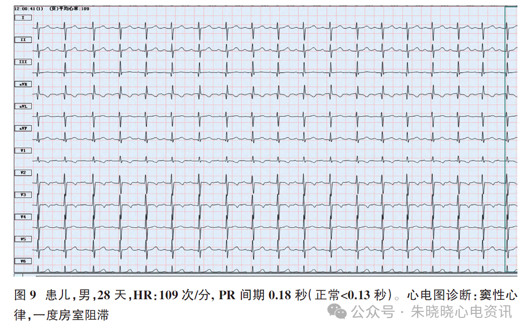 胎儿心电图是什么意思新生儿心电图精要_https://www.jmylbn.com_新闻资讯_第12张