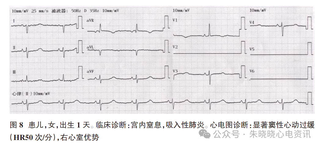 胎儿心电图是什么意思新生儿心电图精要_https://www.jmylbn.com_新闻资讯_第11张