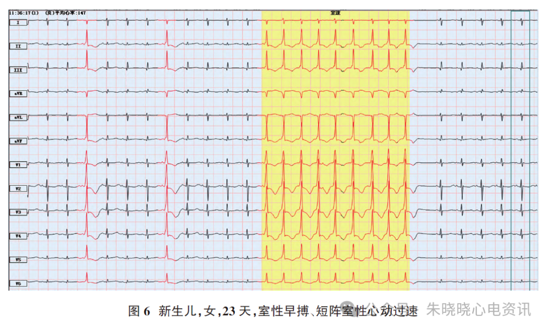 胎儿心电图是什么意思新生儿心电图精要_https://www.jmylbn.com_新闻资讯_第9张