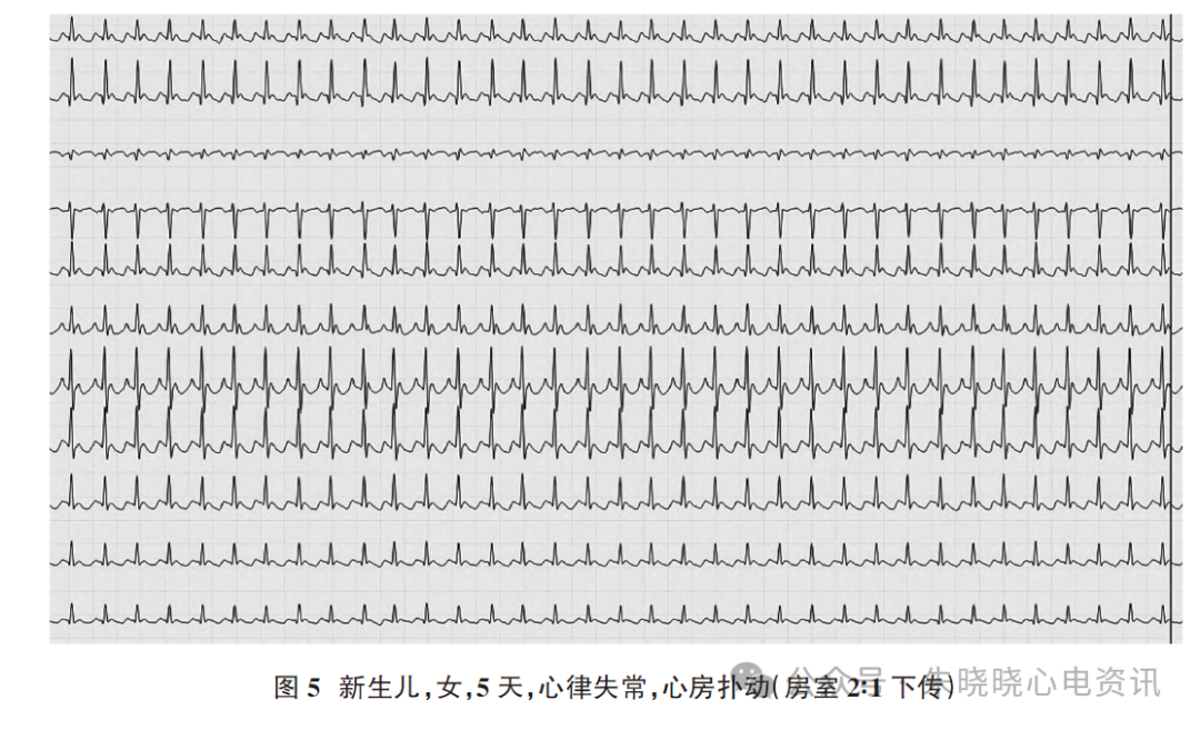 胎儿心电图是什么意思新生儿心电图精要_https://www.jmylbn.com_新闻资讯_第8张