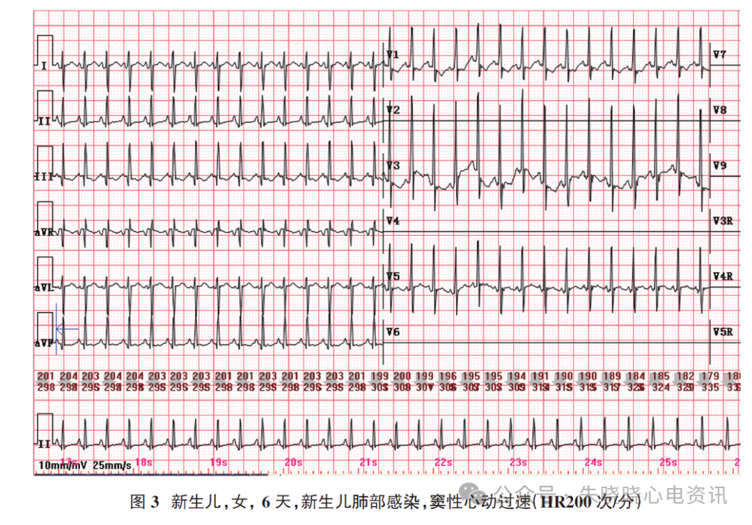 胎儿心电图是什么意思新生儿心电图精要_https://www.jmylbn.com_新闻资讯_第6张