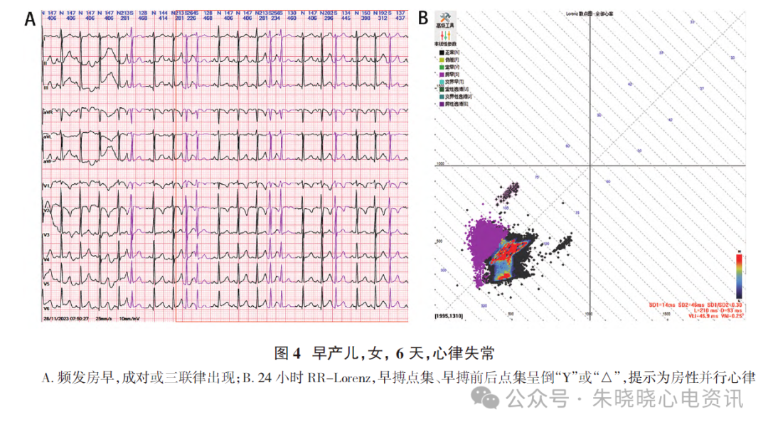 胎儿心电图是什么意思新生儿心电图精要_https://www.jmylbn.com_新闻资讯_第7张