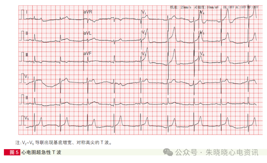 心肌梗死心电图诊断标准和报告规范中国专家共识