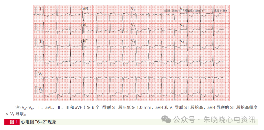 心肌梗死心电图诊断标准和报告规范中国专家共识