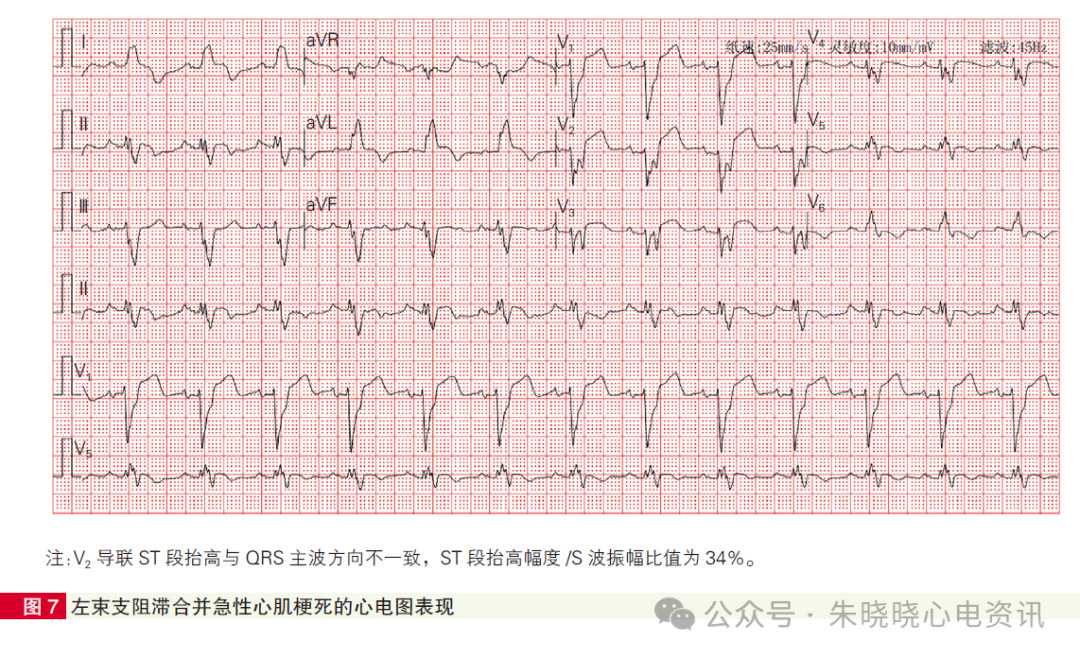 心肌梗死心电图诊断标准和报告规范中国专家共识