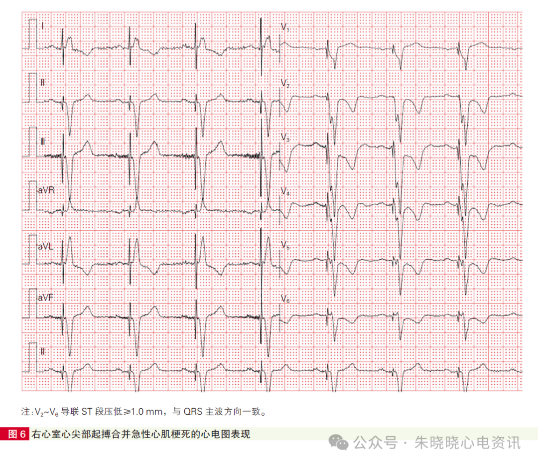 心肌梗死心电图诊断标准和报告规范中国专家共识