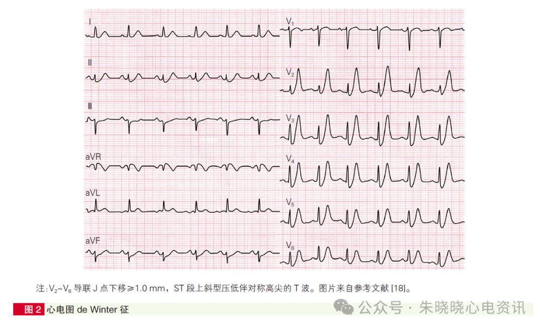心肌梗死心电图诊断标准和报告规范中国专家共识