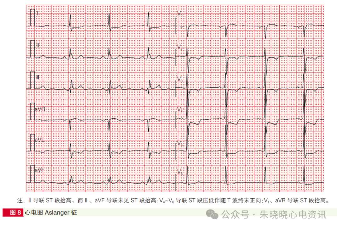 心肌梗死心电图诊断标准和报告规范中国专家共识