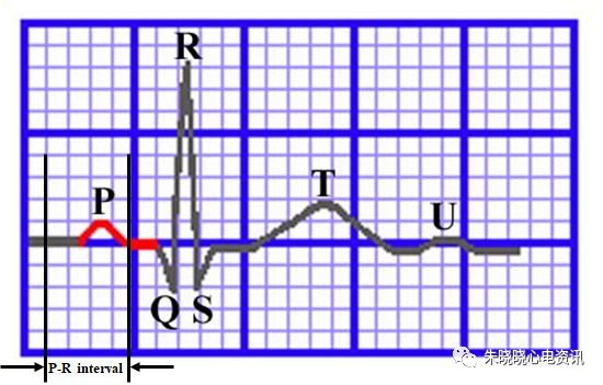 心电图怎么切换导联临床实用心电图入门系列之二：心电图导联、波形及临床价值_https://www.jmylbn.com_新闻资讯_第16张
