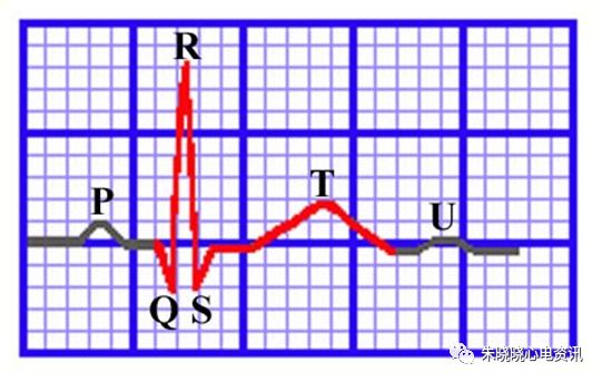 心电图怎么切换导联临床实用心电图入门系列之二：心电图导联、波形及临床价值_https://www.jmylbn.com_新闻资讯_第20张