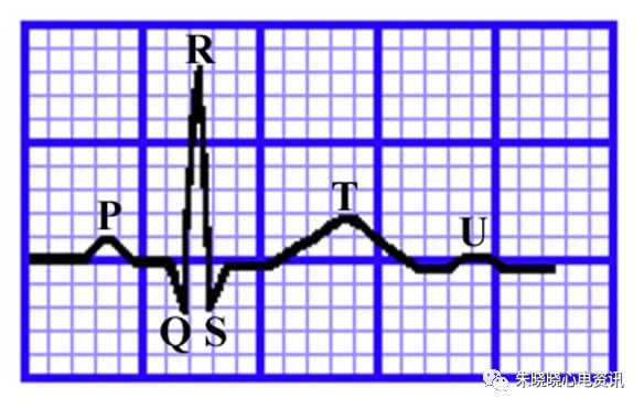 心电图怎么切换导联临床实用心电图入门系列之二：心电图导联、波形及临床价值_https://www.jmylbn.com_新闻资讯_第14张
