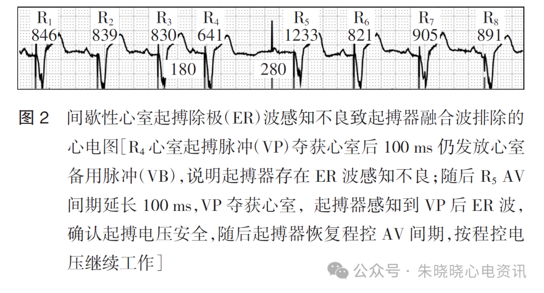 百多力起搏器怎么样起搏器融合波排除的心电图表现_https://www.jmylbn.com_新闻资讯_第4张