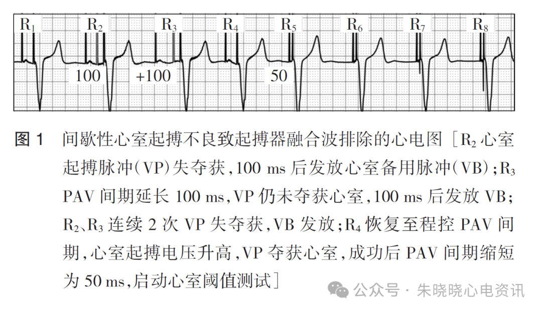 百多力起搏器怎么样起搏器融合波排除的心电图表现_https://www.jmylbn.com_新闻资讯_第3张
