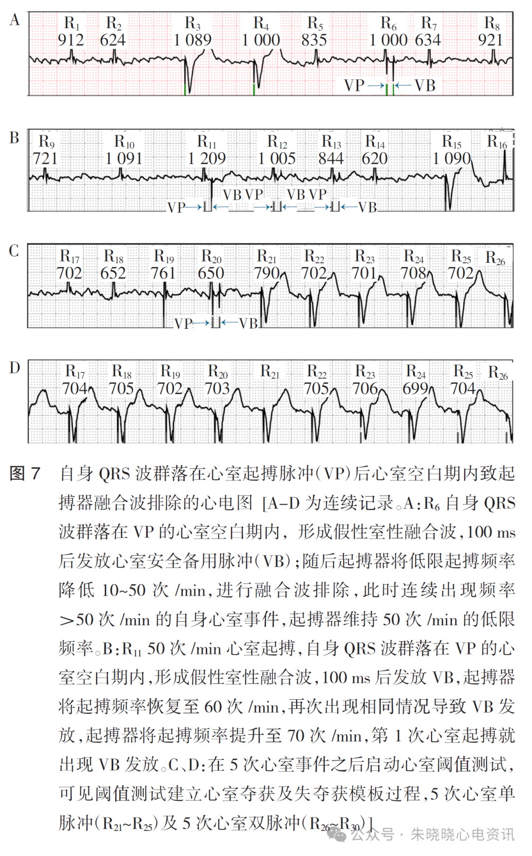 百多力起搏器怎么样起搏器融合波排除的心电图表现_https://www.jmylbn.com_新闻资讯_第9张