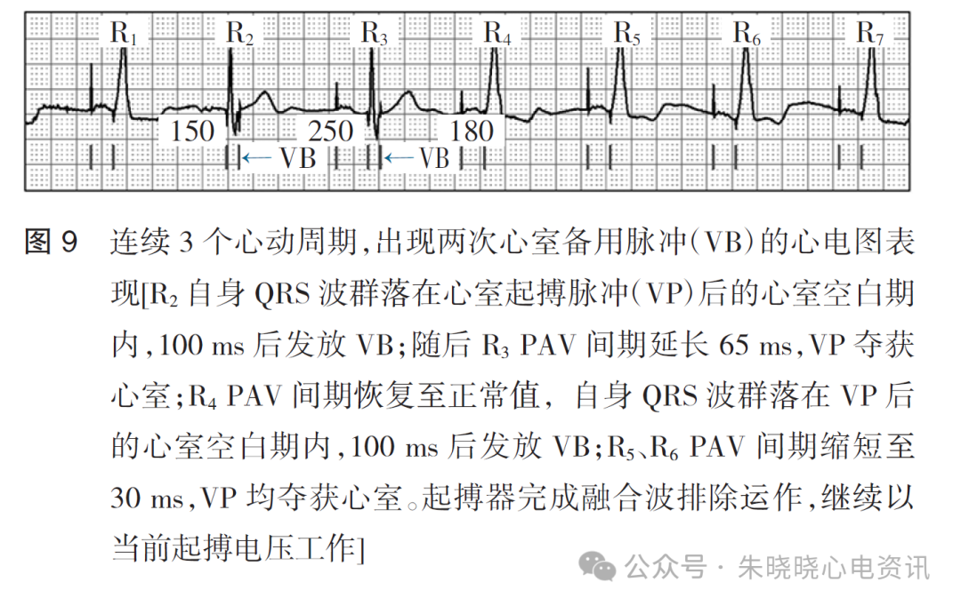 百多力起搏器怎么样起搏器融合波排除的心电图表现_https://www.jmylbn.com_新闻资讯_第11张