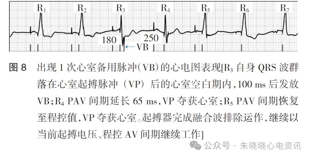 百多力起搏器怎么样起搏器融合波排除的心电图表现_https://www.jmylbn.com_新闻资讯_第10张