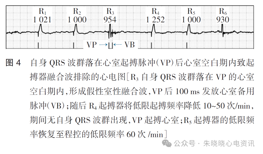 百多力起搏器怎么样起搏器融合波排除的心电图表现_https://www.jmylbn.com_新闻资讯_第6张