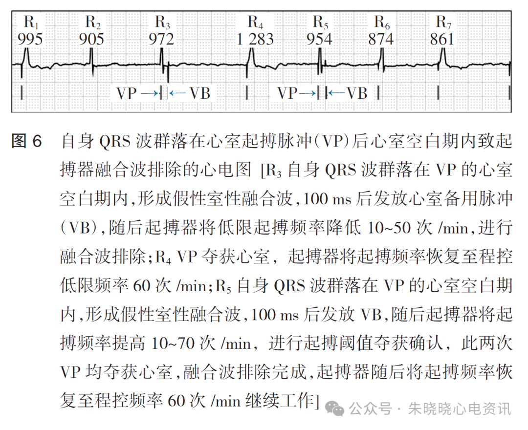百多力起搏器怎么样起搏器融合波排除的心电图表现_https://www.jmylbn.com_新闻资讯_第8张