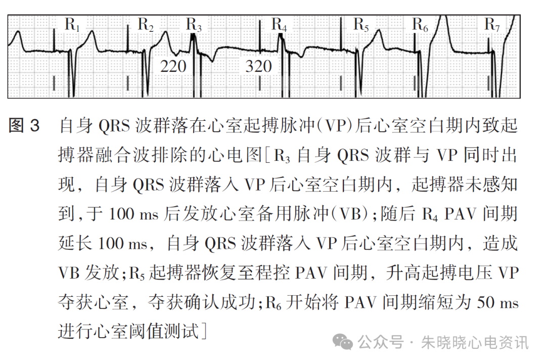 百多力起搏器怎么样起搏器融合波排除的心电图表现_https://www.jmylbn.com_新闻资讯_第5张