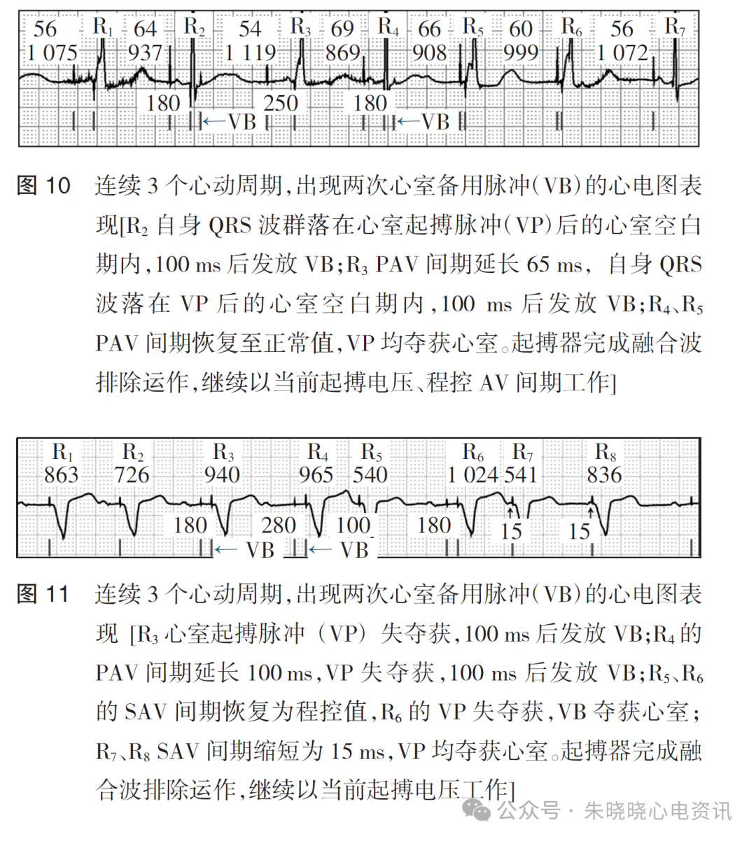 百多力起搏器怎么样起搏器融合波排除的心电图表现_https://www.jmylbn.com_新闻资讯_第12张