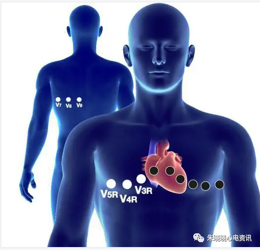 心电图12导怎么组成从12导联到18 导联，你以为只是数字的改变吗？不，这其实更是一场技术的革新！_https://www.jmylbn.com_新闻资讯_第6张