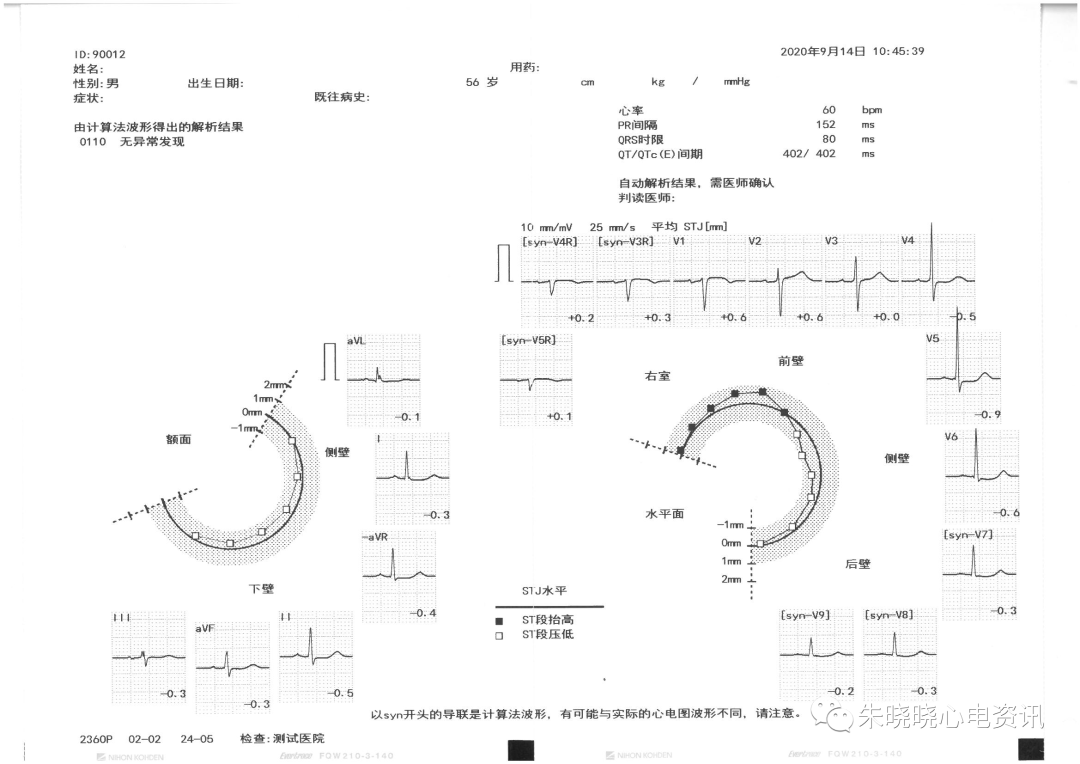 心电图12导怎么组成从12导联到18 导联，你以为只是数字的改变吗？不，这其实更是一场技术的革新！_https://www.jmylbn.com_新闻资讯_第9张