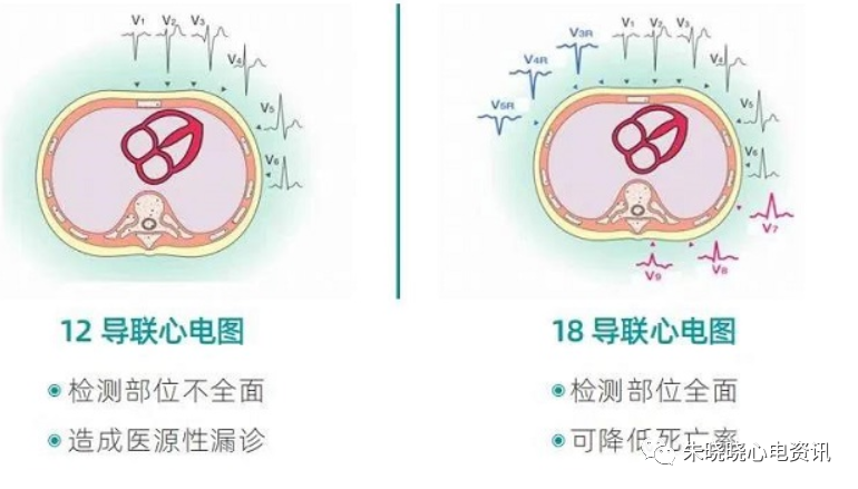 心电图12导怎么组成从12导联到18 导联，你以为只是数字的改变吗？不，这其实更是一场技术的革新！_https://www.jmylbn.com_新闻资讯_第5张