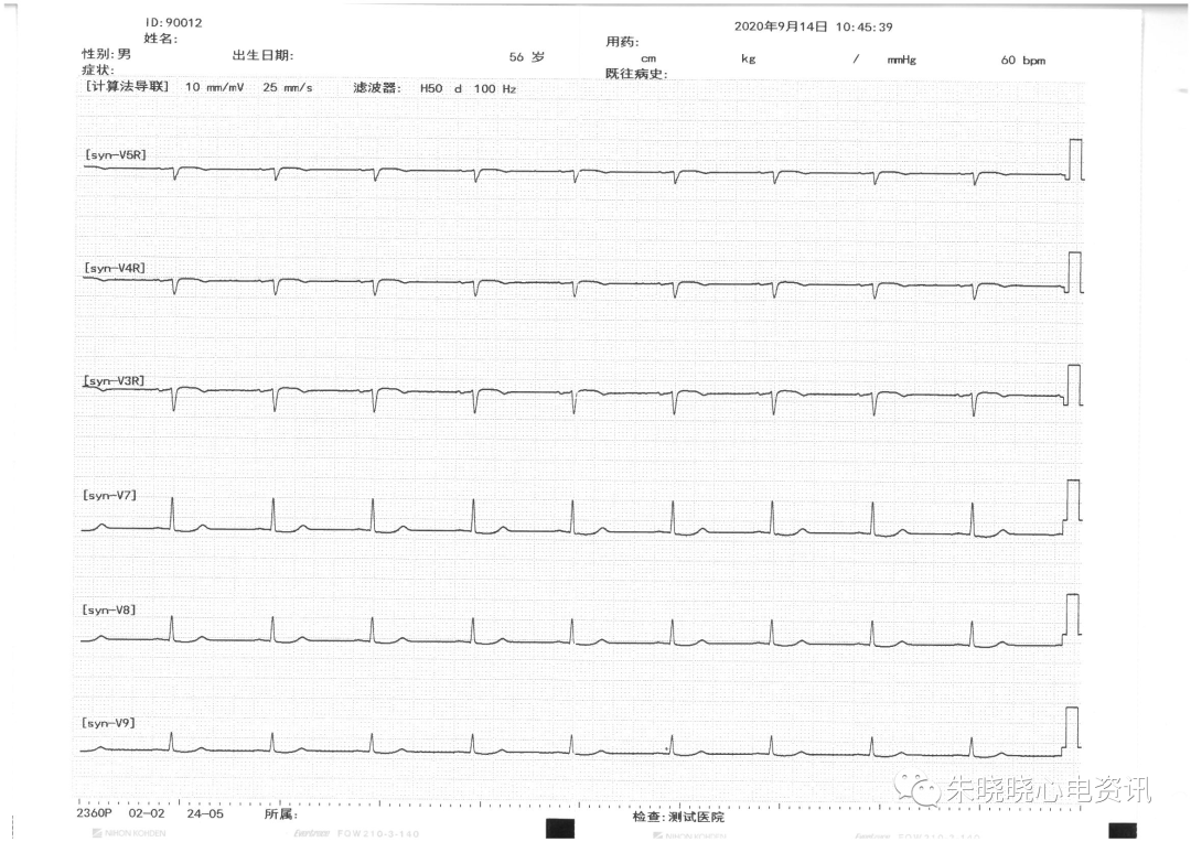 心电图12导怎么组成从12导联到18 导联，你以为只是数字的改变吗？不，这其实更是一场技术的革新！_https://www.jmylbn.com_新闻资讯_第8张