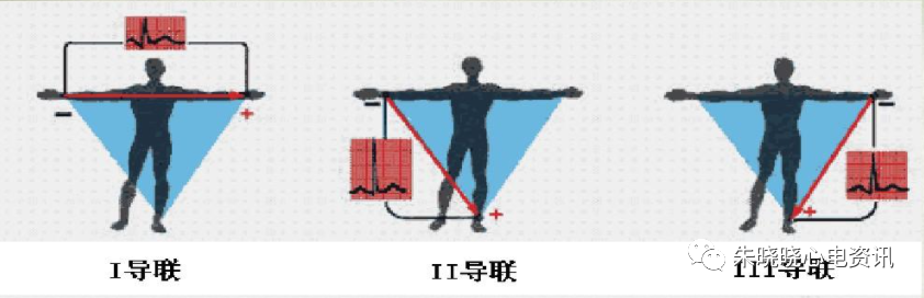 心电图怎么切换导联临床实用心电图入门系列之二：心电图导联、波形及临床价值_https://www.jmylbn.com_新闻资讯_第7张