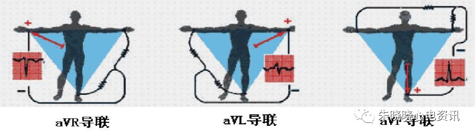 心电图怎么切换导联临床实用心电图入门系列之二：心电图导联、波形及临床价值_https://www.jmylbn.com_新闻资讯_第8张