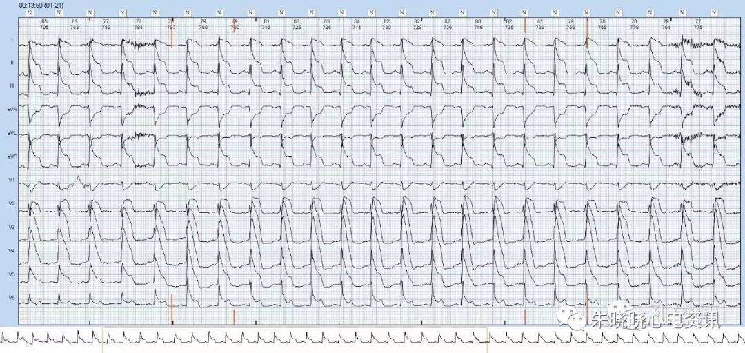 心肌梗死从红旗飘飘到墓碑留名全过程