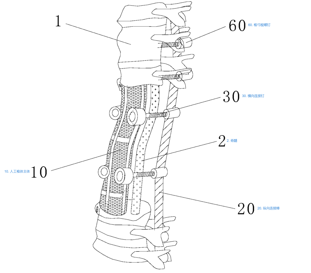 腰椎融合器材有哪些技术分析 ｜ 金属增材制造胸腰椎融合匹配式假体系统 【骨科创新医械】_https://www.jmylbn.com_新闻资讯_第6张