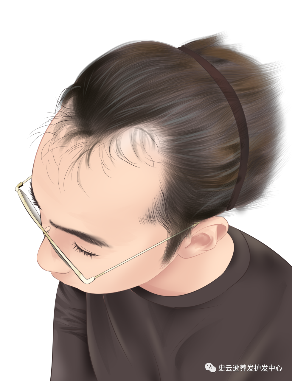 发际线后移是可逆的！教你三招拯救发际线