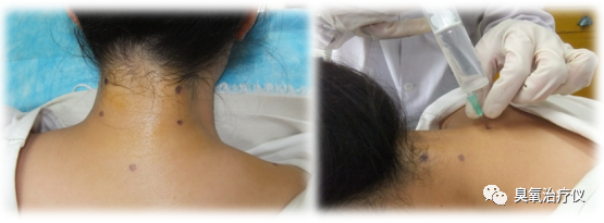 医用臭氧有什么作用医用臭氧水注射治疗之临床应用_https://www.jmylbn.com_新闻资讯_第12张