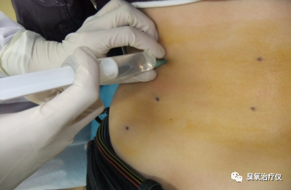 医用臭氧有什么作用医用臭氧水注射治疗之临床应用_https://www.jmylbn.com_新闻资讯_第6张