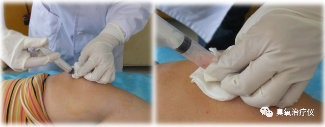 医用臭氧有什么作用医用臭氧水注射治疗之临床应用_https://www.jmylbn.com_新闻资讯_第9张