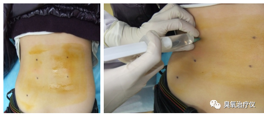 医用臭氧有什么作用医用臭氧水注射治疗之临床应用_https://www.jmylbn.com_新闻资讯_第14张