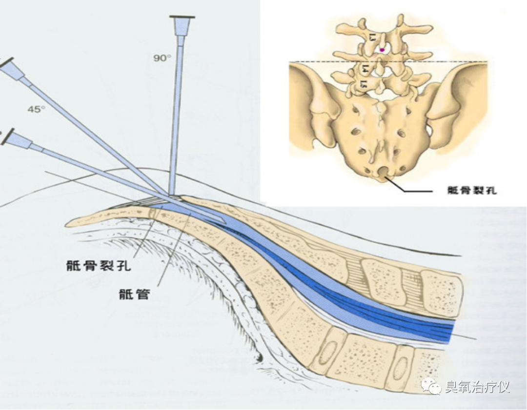 医用臭氧有什么作用医用臭氧水注射治疗之临床应用_https://www.jmylbn.com_新闻资讯_第13张