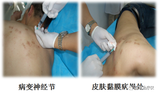 医用臭氧有什么作用医用臭氧水注射治疗之临床应用_https://www.jmylbn.com_新闻资讯_第11张