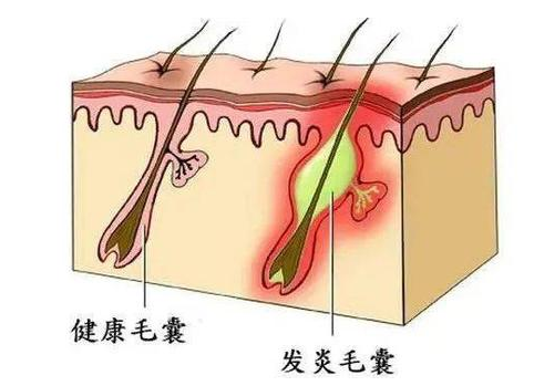 毛囊炎症状，图片，注意事项