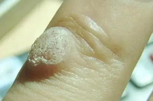 二氧化碳(co2)激光治疗是什么【科普】这些皮肤问题，可以用二氧化碳激光解决_https://www.jmylbn.com_新闻资讯_第12张