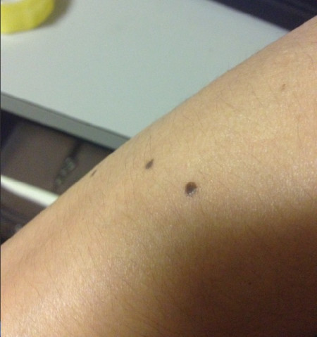 二氧化碳(co2)激光治疗是什么【科普】这些皮肤问题，可以用二氧化碳激光解决_https://www.jmylbn.com_新闻资讯_第11张