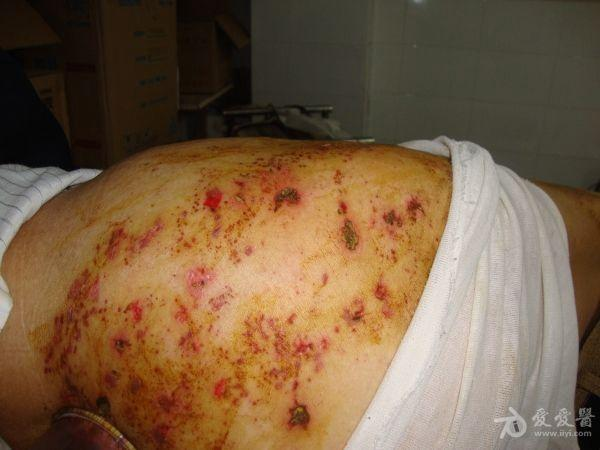 二氧化碳(co2)激光治疗是什么【科普】这些皮肤问题，可以用二氧化碳激光解决_https://www.jmylbn.com_新闻资讯_第14张