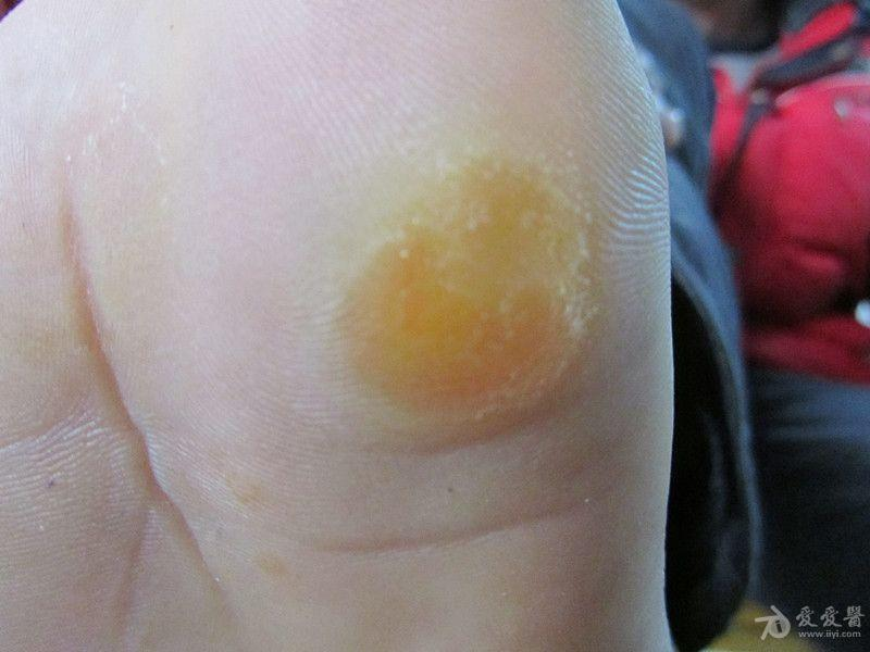 二氧化碳(co2)激光治疗是什么【科普】这些皮肤问题，可以用二氧化碳激光解决_https://www.jmylbn.com_新闻资讯_第15张