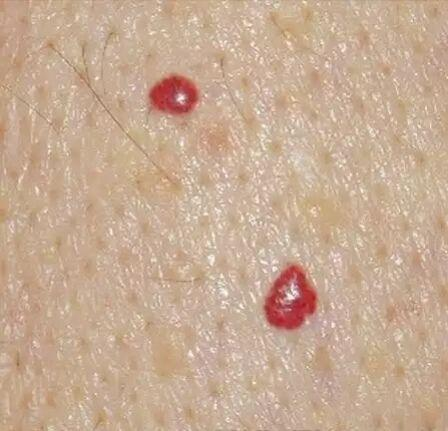 二氧化碳(co2)激光治疗是什么【科普】这些皮肤问题，可以用二氧化碳激光解决_https://www.jmylbn.com_新闻资讯_第10张