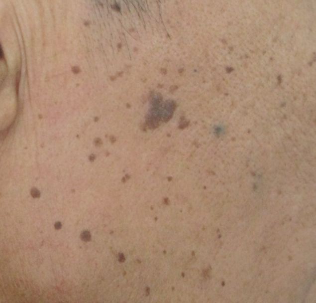 二氧化碳(co2)激光治疗是什么【科普】这些皮肤问题，可以用二氧化碳激光解决_https://www.jmylbn.com_新闻资讯_第13张